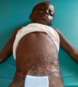 Die 5jährige Mary aus Ntronang hat bei einem Feuerunfall schwerste Verbrennungen erlitten, das Mädchen benötigt dringend eine Operation. Foto: Privat